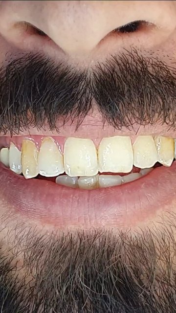 مشاوره رایگان برای رنگ کامپوزیت دندان 💎🦷