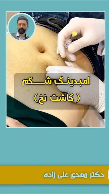 امبدینگ، روش طبیعی برای کاهش جربی ها و لاغری
