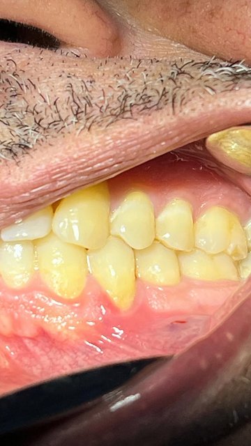 گزارش رایگان جراحی انتقال بافت لثه