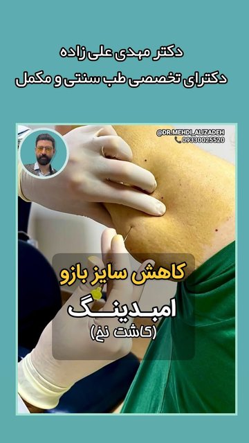 روش طبیعی کاهش وزن با امبدینگ