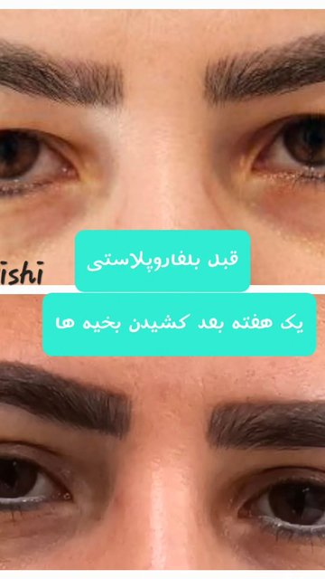 تاثیر زمان بر رد بخیه بلفاروپلاستی