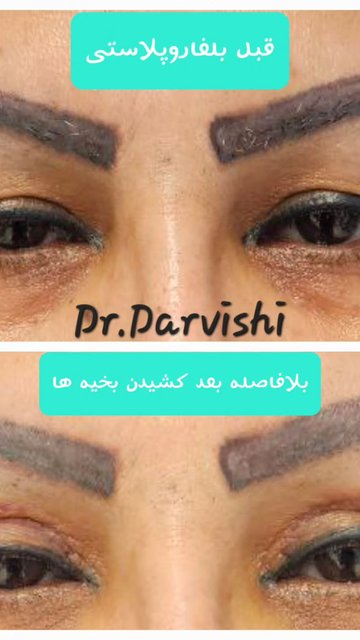 جراحی بالفاروپلاستی برای بهبود شکل چشمان