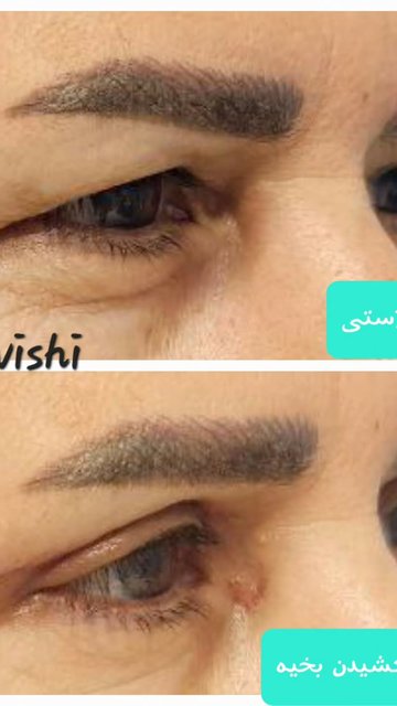 زیبایی چشم با جراحی تخصصی پلک 😍