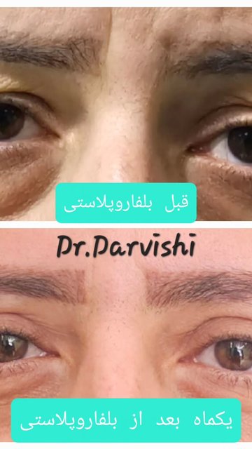 شکافتن پلک ها، شادی در چشم ها