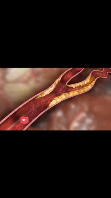 آنژیوگرافی و آنژیوپلاستی، علاج عروق کرونر