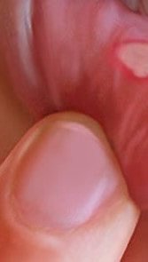 علل آفت زدن پس از دندانپزشکی