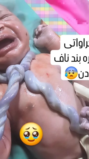 زایمان جنین با دو گره در ناف