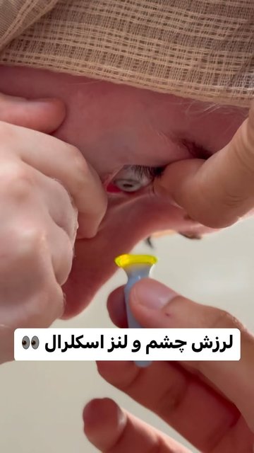 نیستاگموس، لنزهای اسکلرال برای بهبود بینایی