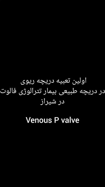 نتیجه موفق عمل دریچه قلب بیمار ۱۳ ساله