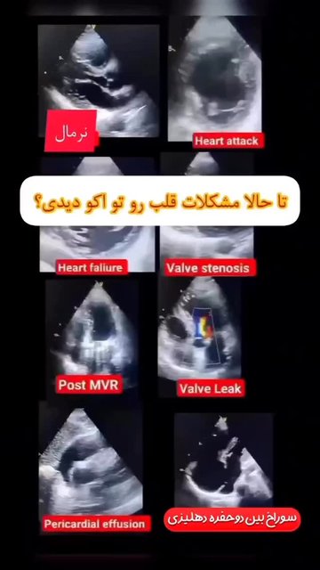 تشخیص بیماریهای قلب با دستگاه اکو کاردیو گرافی