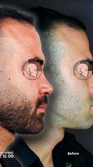 نتیجه جراحی فک پایین و چانه بعد از یک سال، ارتودنسی بدون!