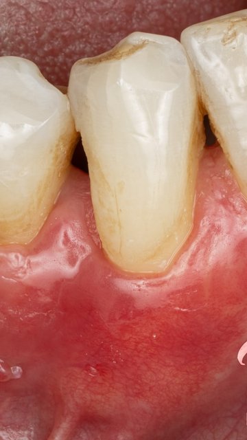 جراحی پیوند لثه؛ نتیجه و پیامدها در ۳ هفته