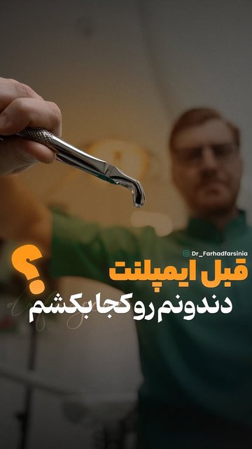 اهمیت مشورت قبل از درمان ایمپلنت