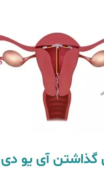 استفاده از دستگاه IUD برای پیشگیری از بارداری