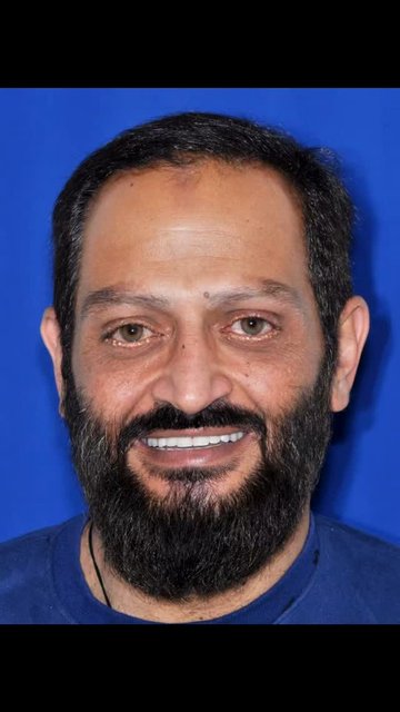 بازسازی کامل با ایمپلنت های مگاژن لاین