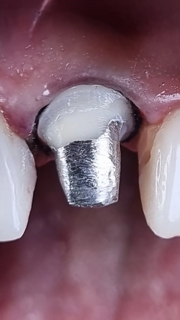 دندانپزشکی، آماده سازی و روکش دندان