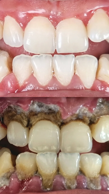 اهمیت جرم گیری برای بهبود سلامت دهان