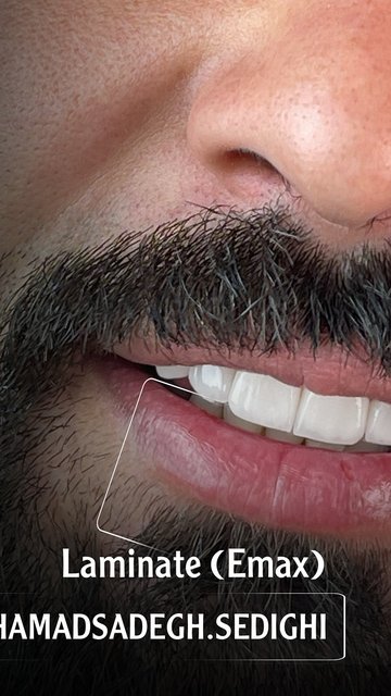 لمینیت، طراحی و روکش سرامیکی برای لبخند