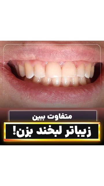 ونیر کامپوزیت برای زیبایی دندان های شما
