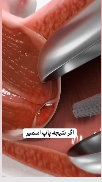 غربالگری زودرس سرطان دهانه رحم با پاپ اسمیر.