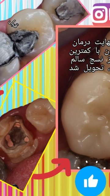 اصلاح دندان مخروب با تکنولوژی دیجیتال و لیزر