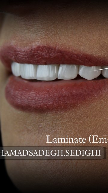 Laminate Veneers for Perfect Smile Design