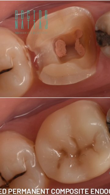 مراحل درمان اندوکراون کامپوزیتی در دو ساعت