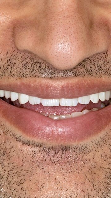 A Smile, One Year in the Making.