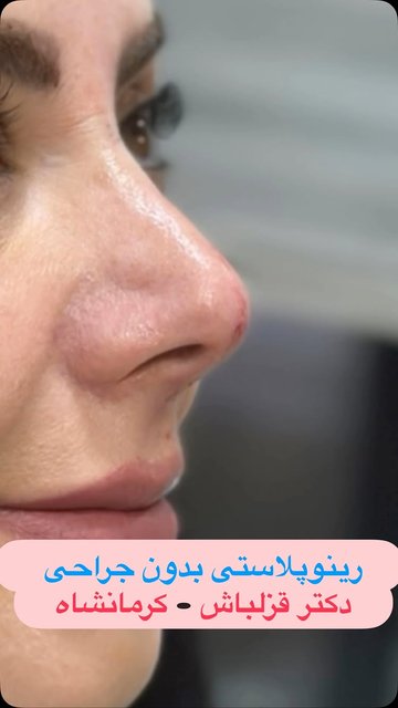 تزریق فیلر بینی، اصلاح بدون جراحی