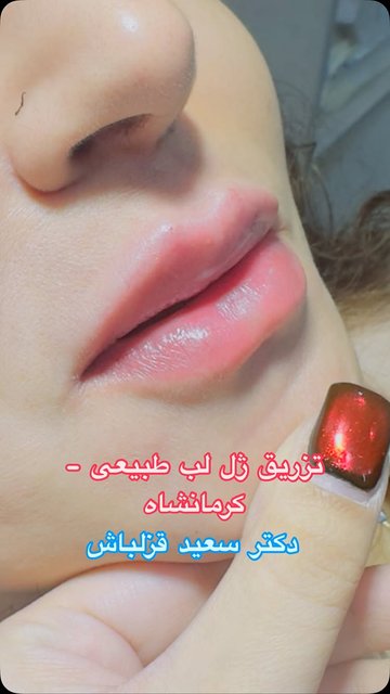 تکنیک Bi-Bi Lips، دقت طبیعی با فیلرهای دولایه
