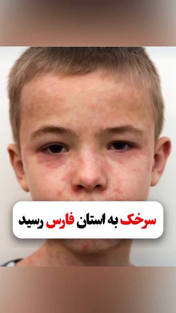 آلودگی سرخک؛ واکسن بهترین راه پیشگیری