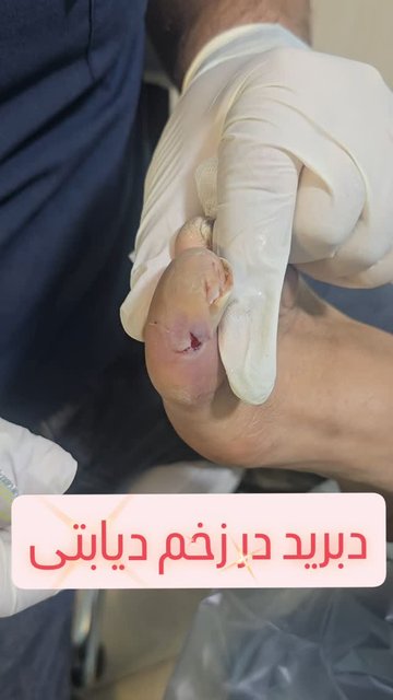 دبرید موثر، نجات زخم با اصولی به موقع