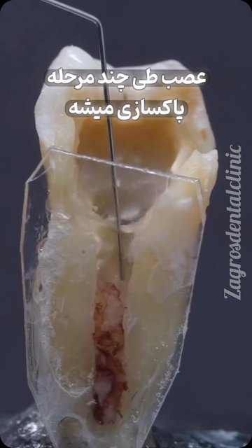 عصب کشی تخصصی و مجدد در کلینیک زاگرس