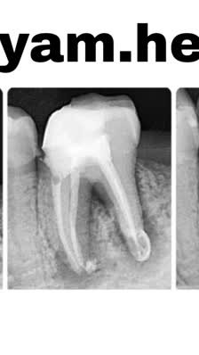 ریشه نگاری؛ نجات دندان از عفونت