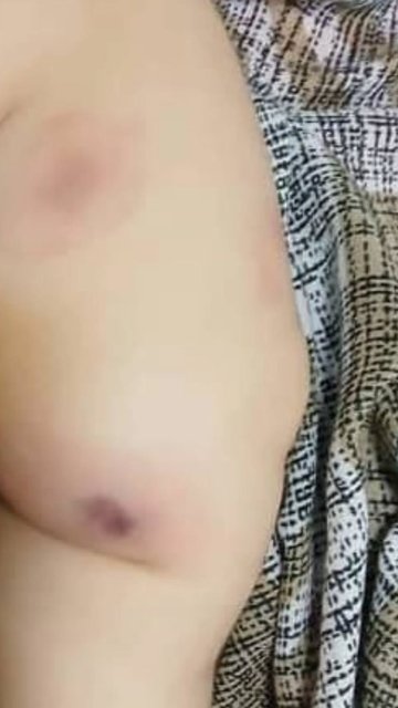 Baby with annular lesion improved after treatment.