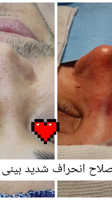 جراحی بینی برای بیمار با کجی شدید