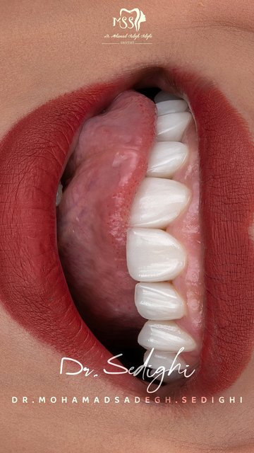 لابه لبخندی زیبا با لامینیت های سرامیکی ایمکس