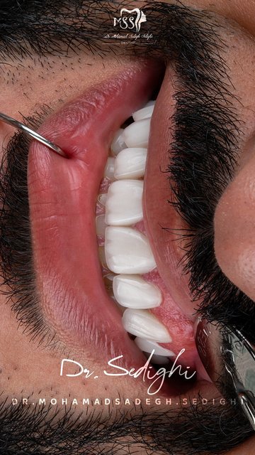 لبخند زیبا با لامینیت سرامیکی ایمکس