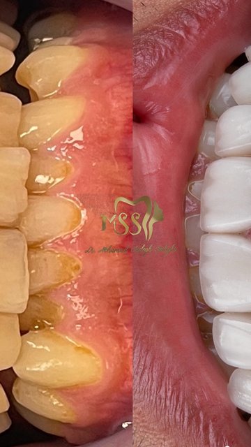 طراحی لبخند با لامینیت های سرامیکی ایمکس