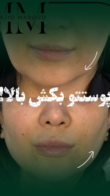 لیفت صورت با نخ، روشی غیرتهاجمی و موثر