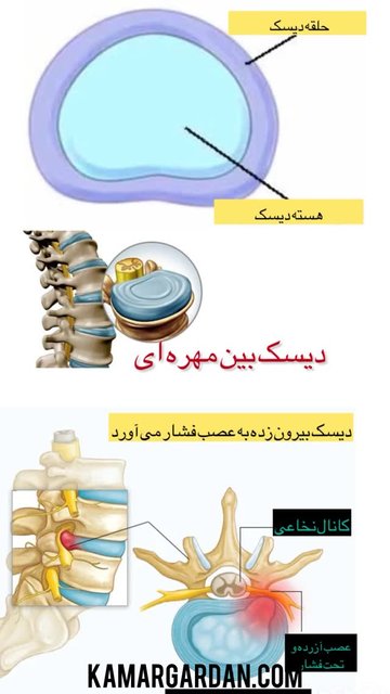 درد سیاتیک، خصوصیات و درمان ها