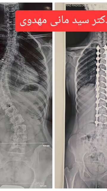 دختر پانزده ساله اسکولیوز شصت درجه، عمل جراحی