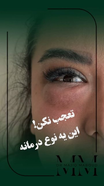 کربوکسی تراپی، روشی برای رفع تیرگی دور چشم