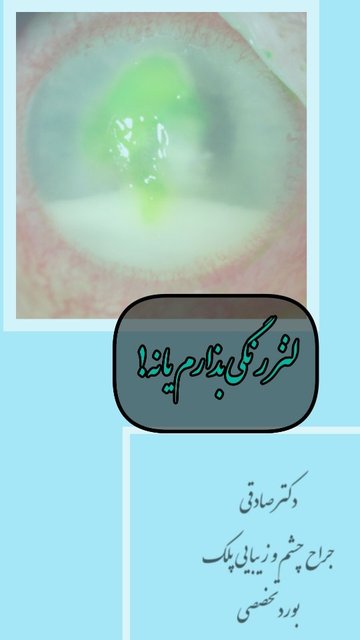 خطرات لنز رنگی برای چشم ها پیشگیری شود