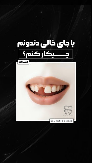 انتخاب ایمپلنت یا بریج برای پر کردن خالی دندان؟
