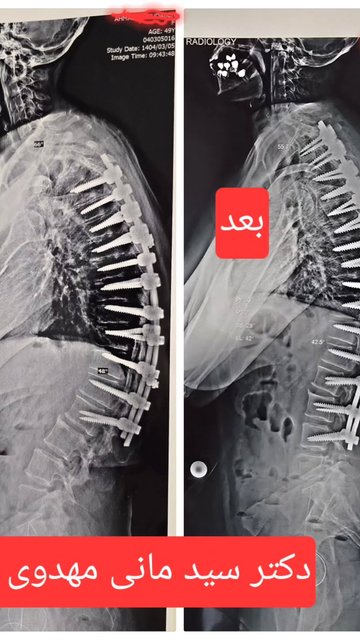انتخاب صحیح مهره برای جراحی کیفوز و اسکولیوز