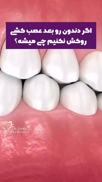 ضرورت انجام روکش برای دندان های عصب کشیده شده