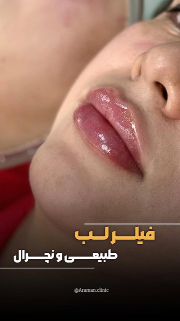 پر شکوه و زیبا با فیلر لب طبیعی