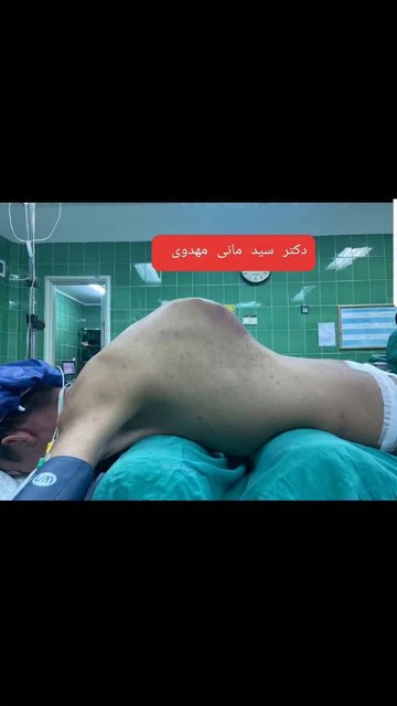 تکنیک کیفوز صد و شصت درجه