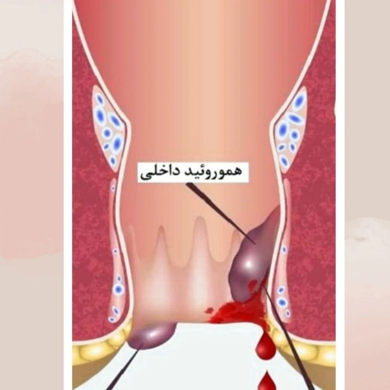 آنال، عوارض و خطرات مختلف برای سلامتی